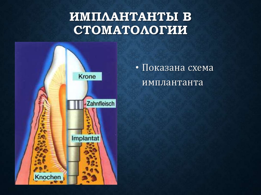 Имплантанты в стоматологии