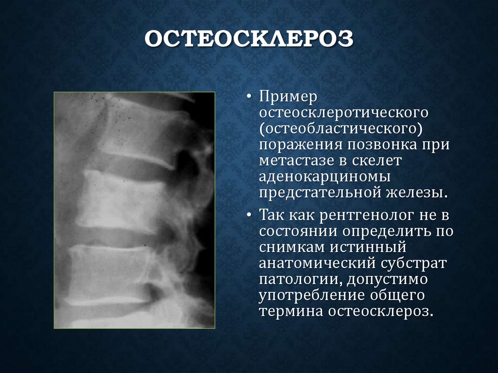 Остеосклероз