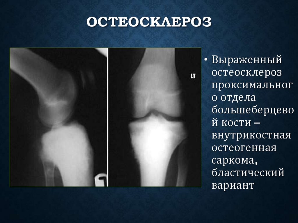 Остеосклероз