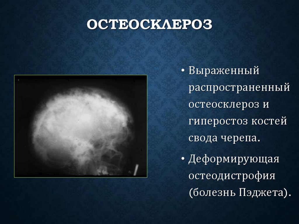 Остеосклероз