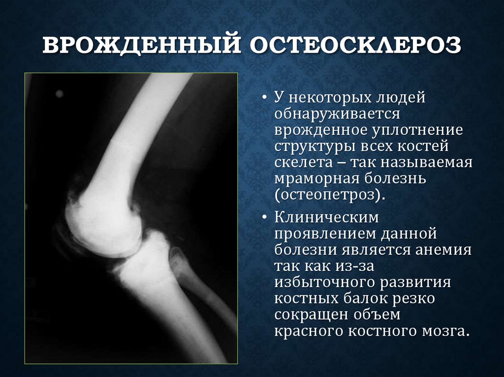 Врожденный остеосклероз