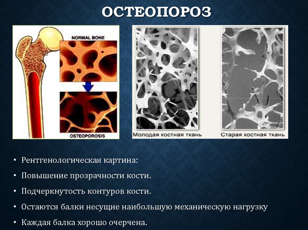 Остеопороз
