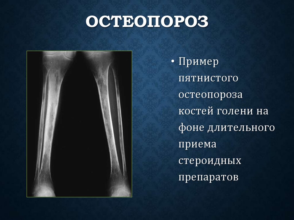 Остеопороз