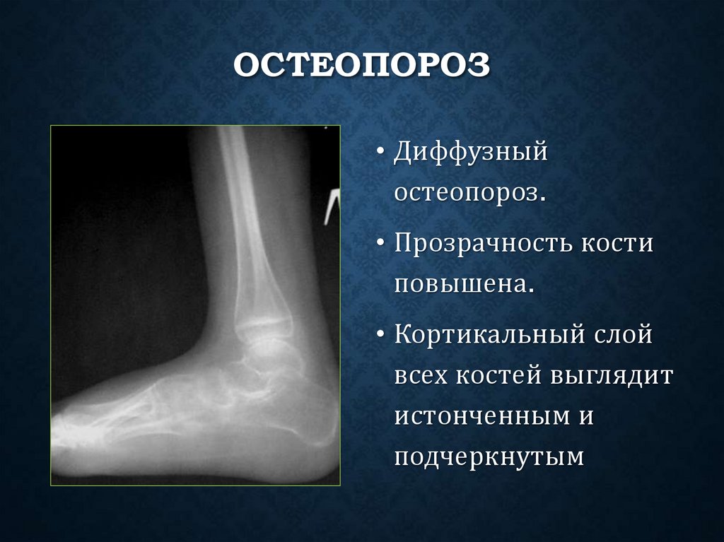 Остеопороз