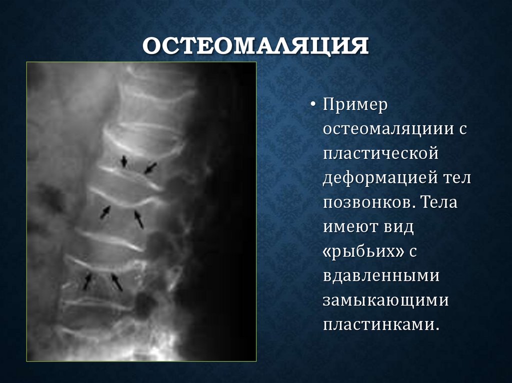 Остеомаляция