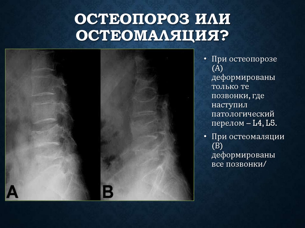 Остеопороз или остеомаляция?