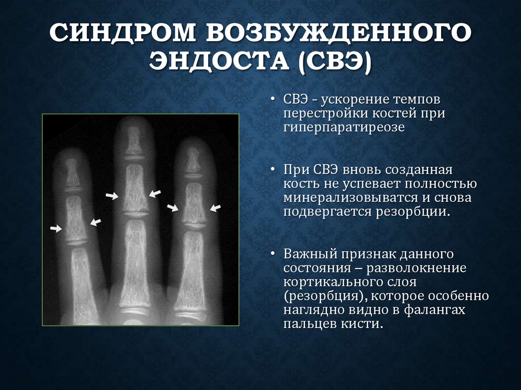 Синдром возбужденного эндоста (СВЭ)