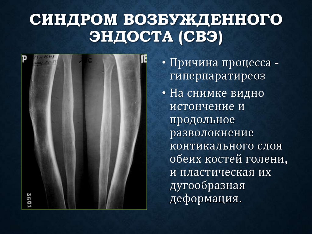 Синдром возбужденного эндоста (СВЭ)