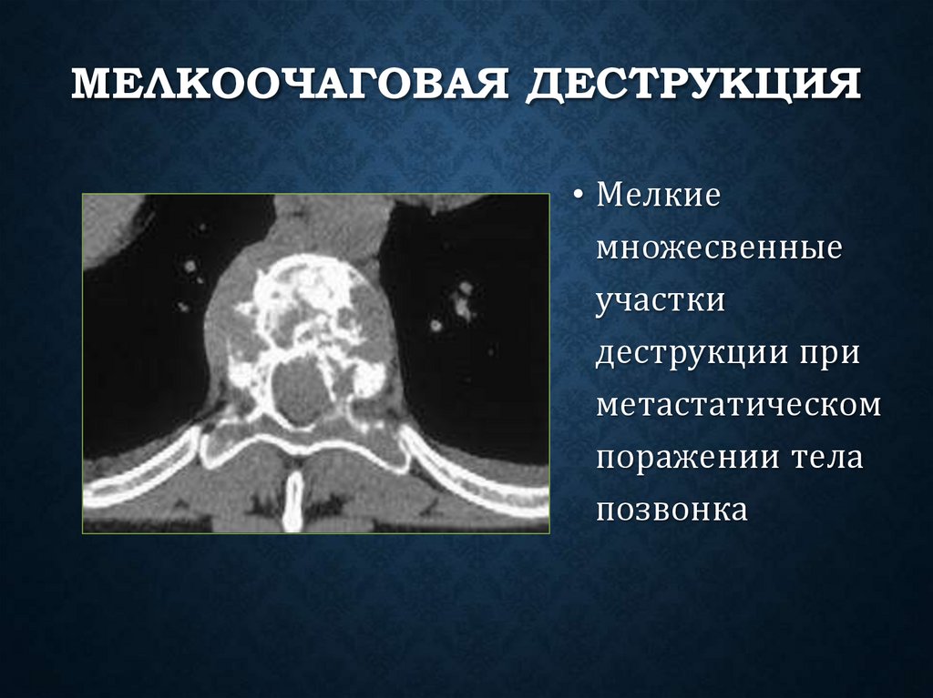 Мелкоочаговая деструкция