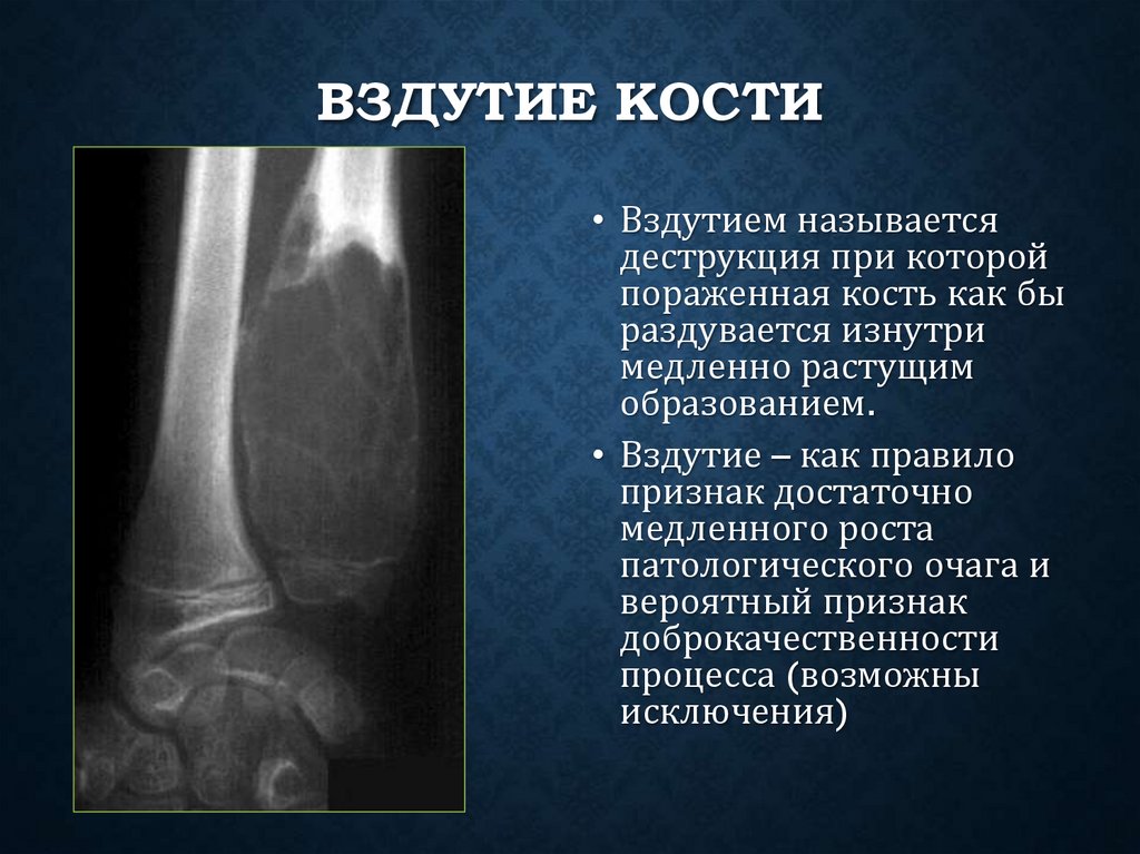 Вздутие кости