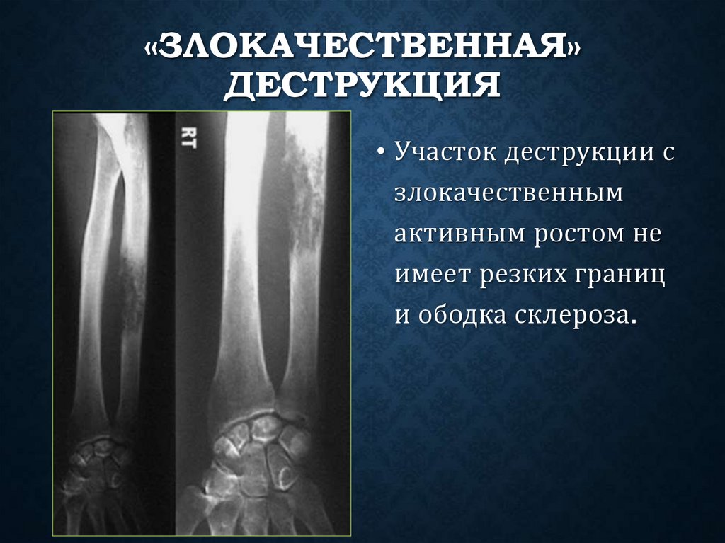 «Злокачественная» деструкция