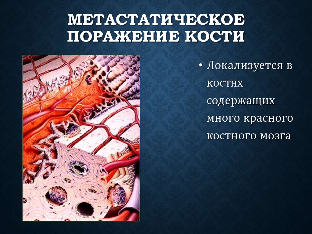 Метастатическое поражение кости