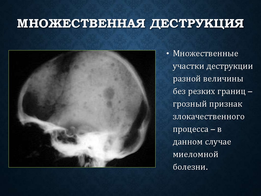 Множественная деструкция
