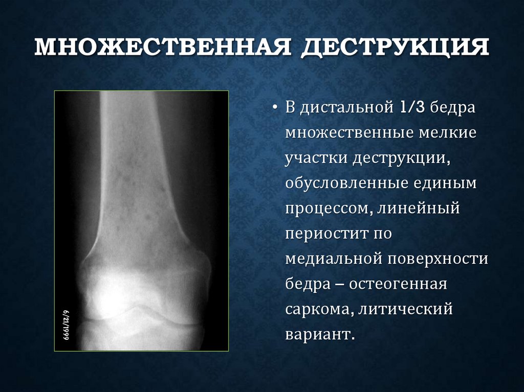 Множественная деструкция