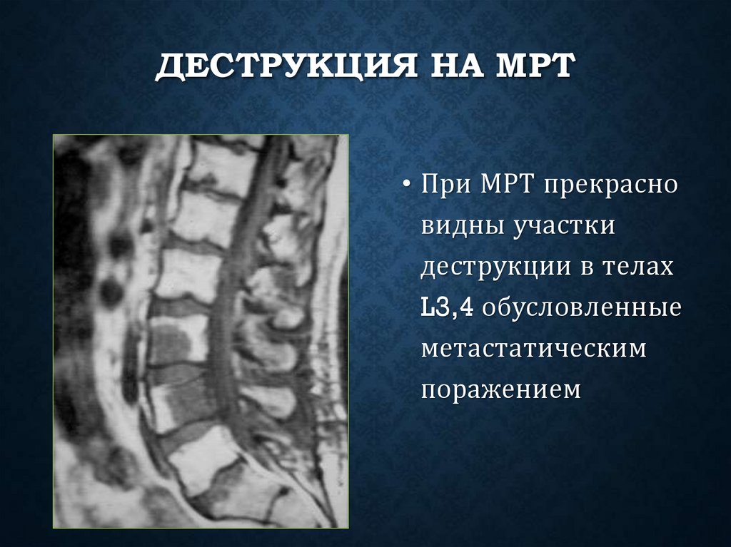 Деструкция на МРТ