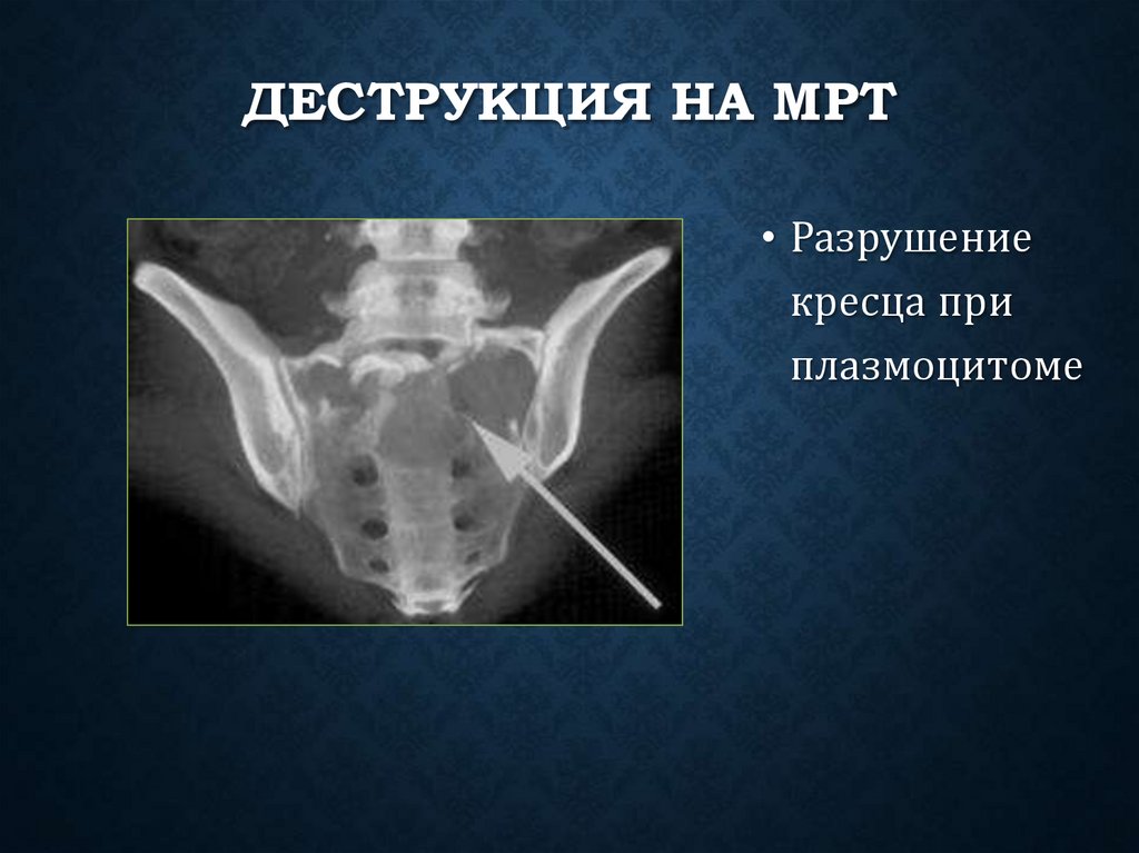 Деструкция на МРТ