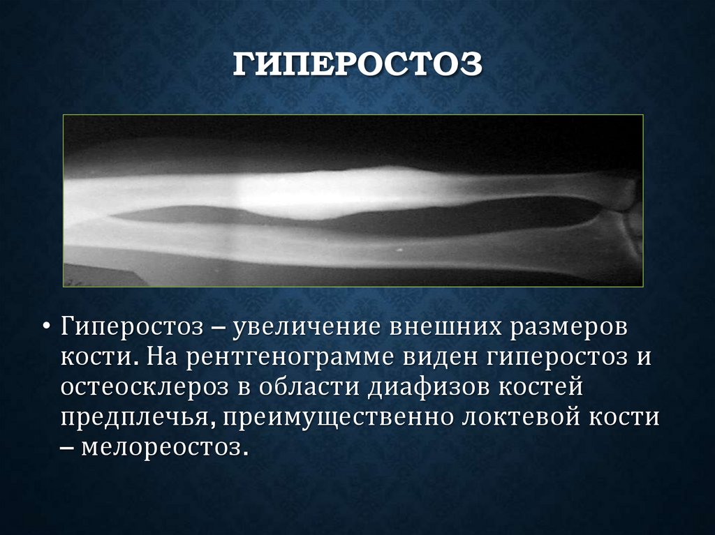 Гиперостоз