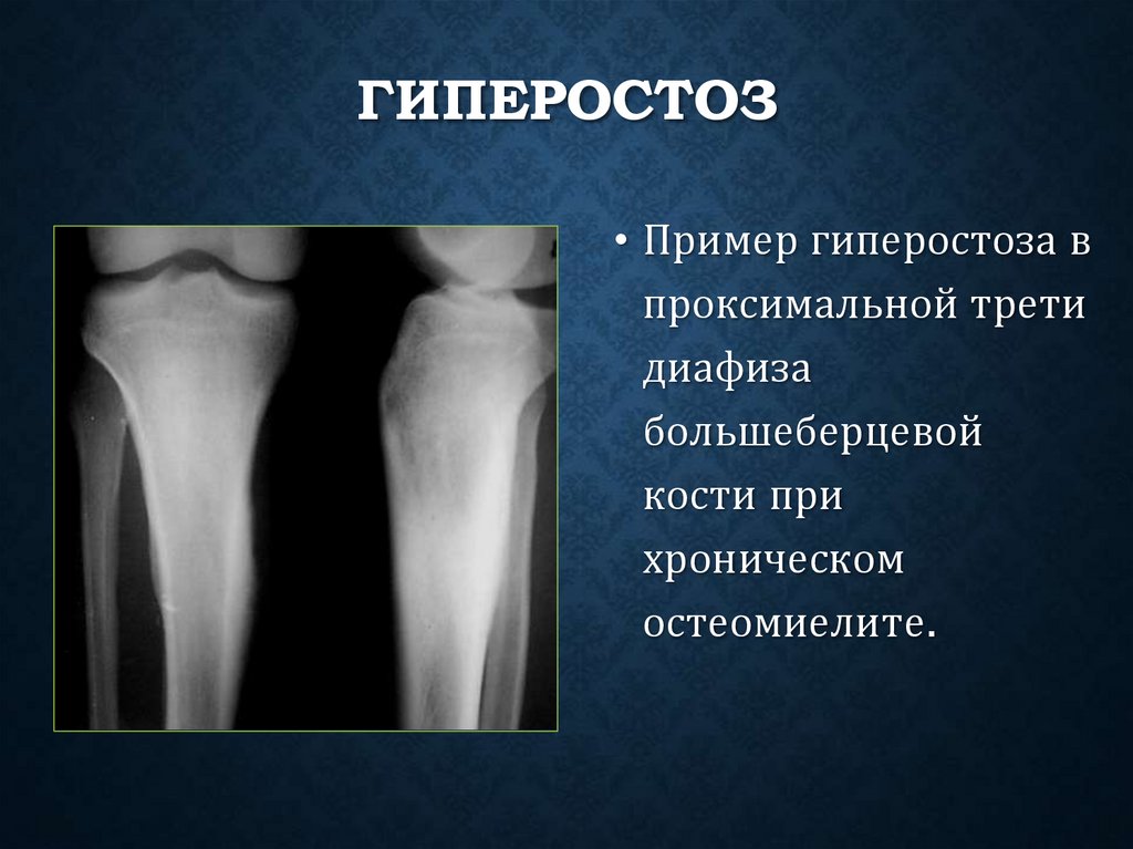 Гиперостоз