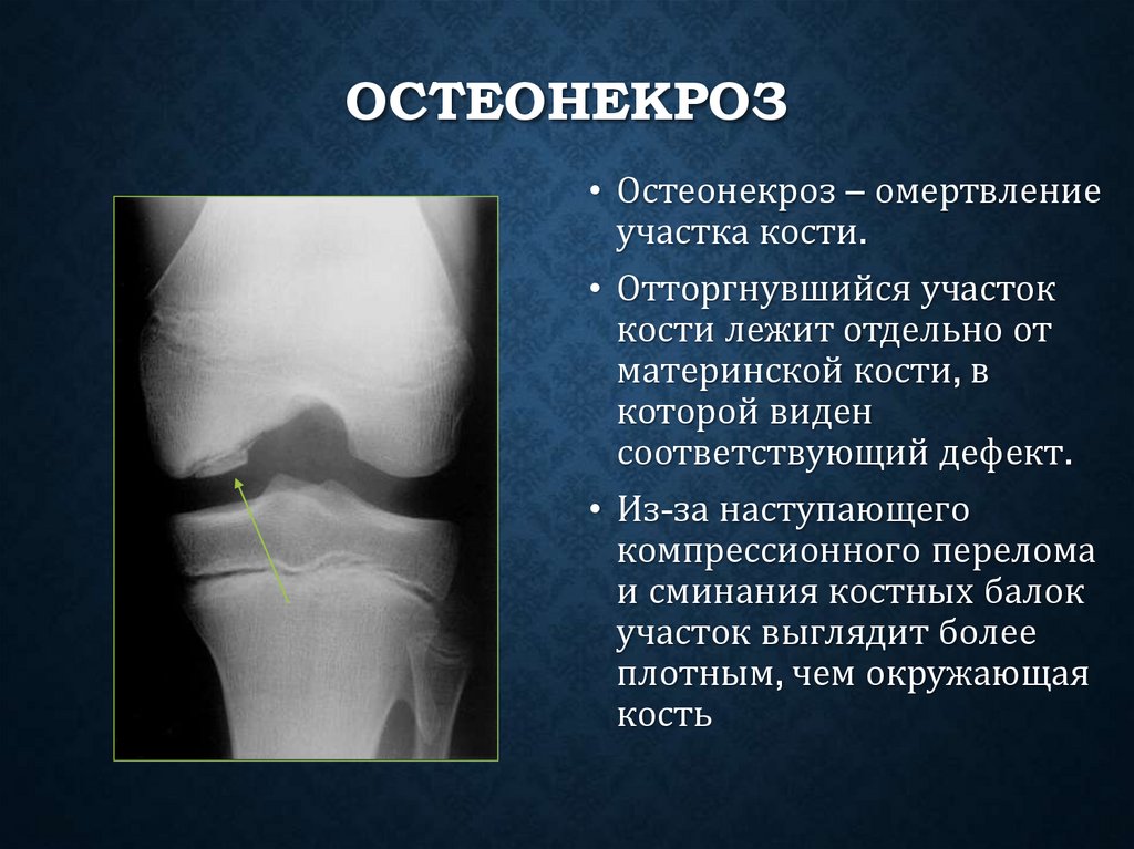 Остеонекроз