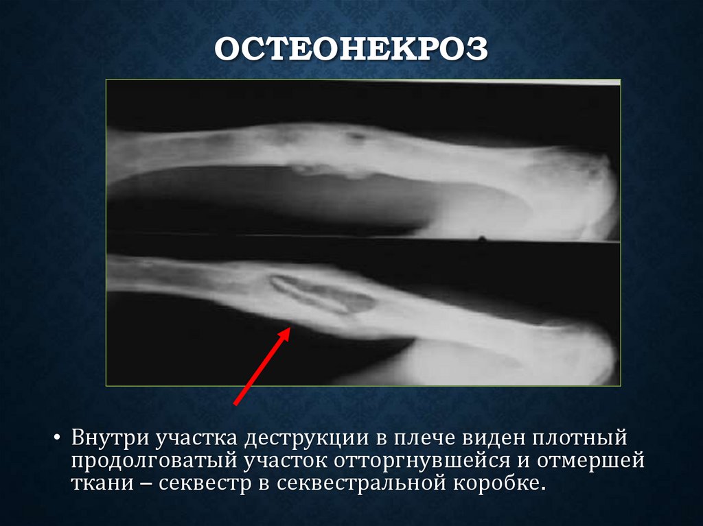 Остеонекроз