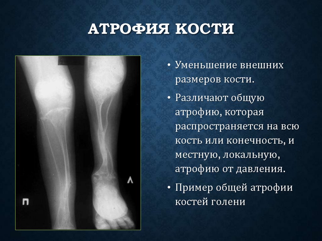 Атрофия кости