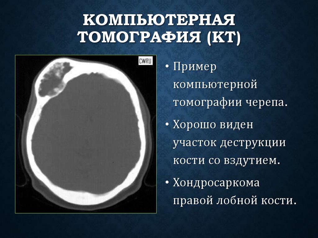 Компьютерная томография (КТ)