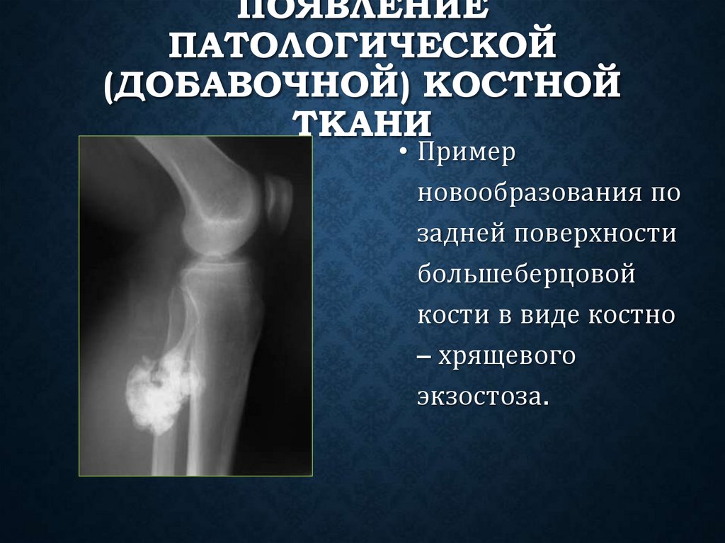 Появление патологической (добавочной) костной ткани