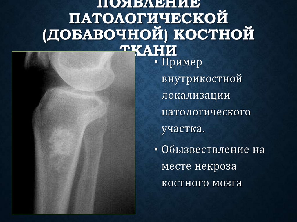 Появление патологической (добавочной) костной ткани