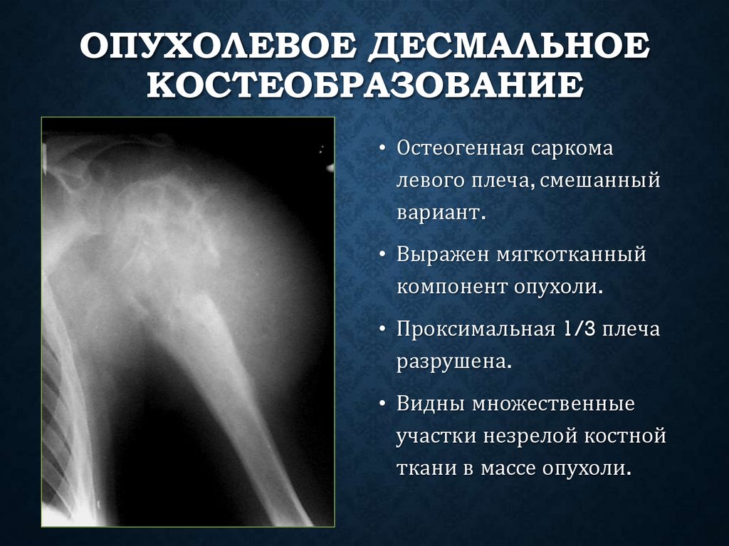 Опухолевое десмальное костеобразование