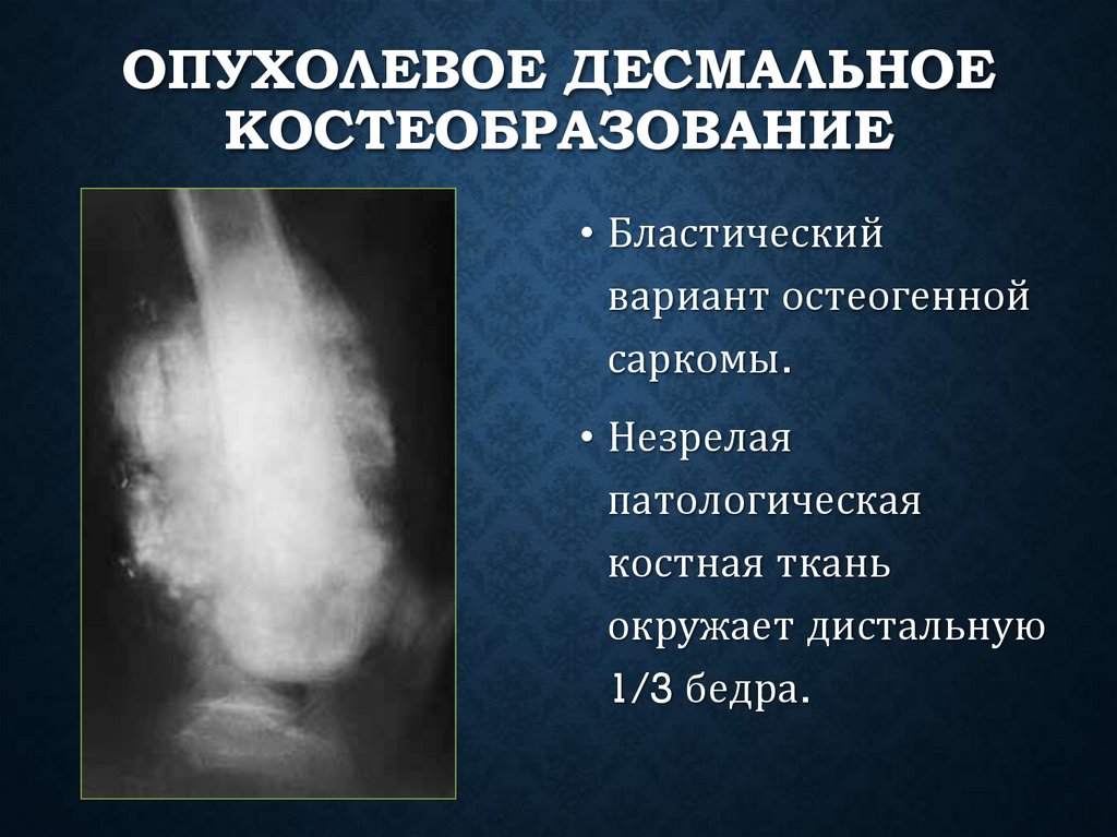 Опухолевое десмальное костеобразование