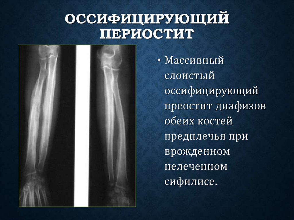 Оссифицирующий периостит