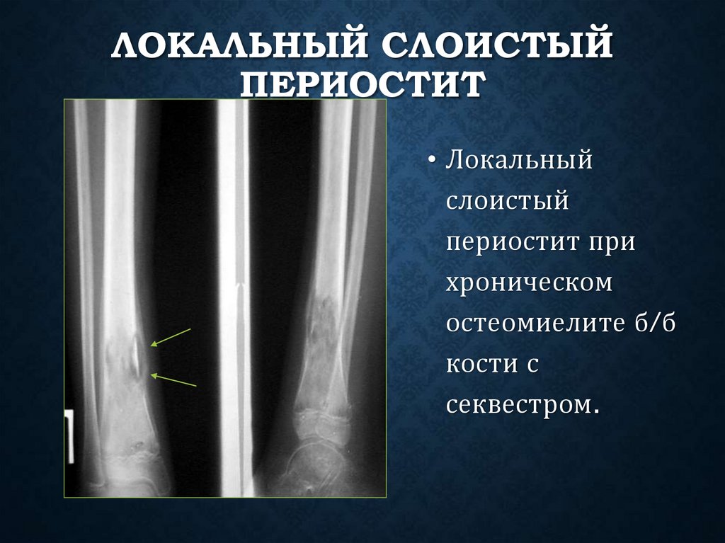 Локальный слоистый периостит