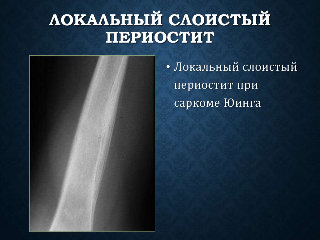 Локальный слоистый периостит