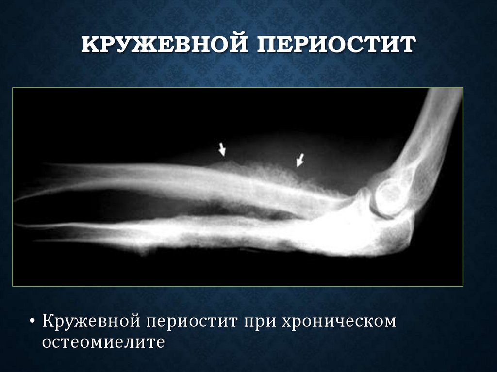 Кружевной периостит