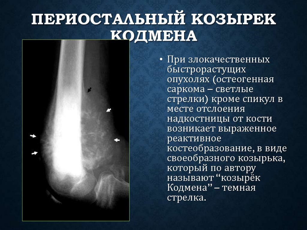 Периостальный козырек Кодмена