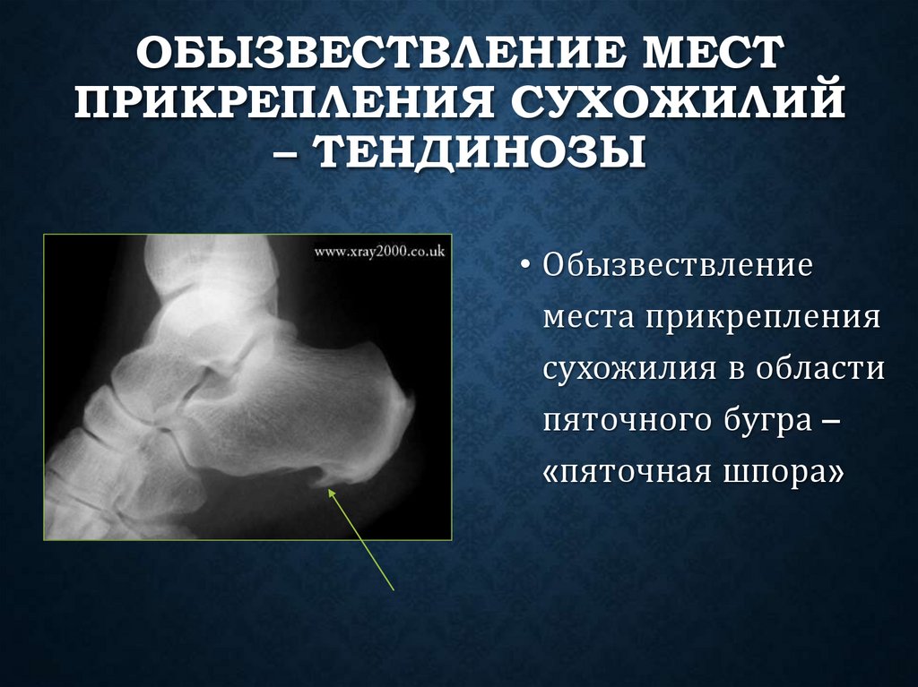 Обызвествление мест прикрепления сухожилий – тендинозы