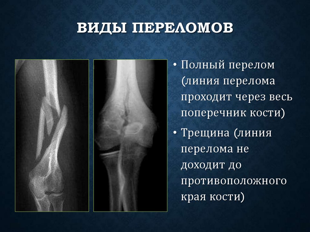 Виды переломов