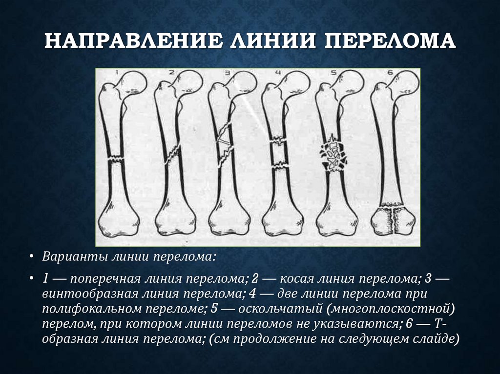 Направление линии перелома
