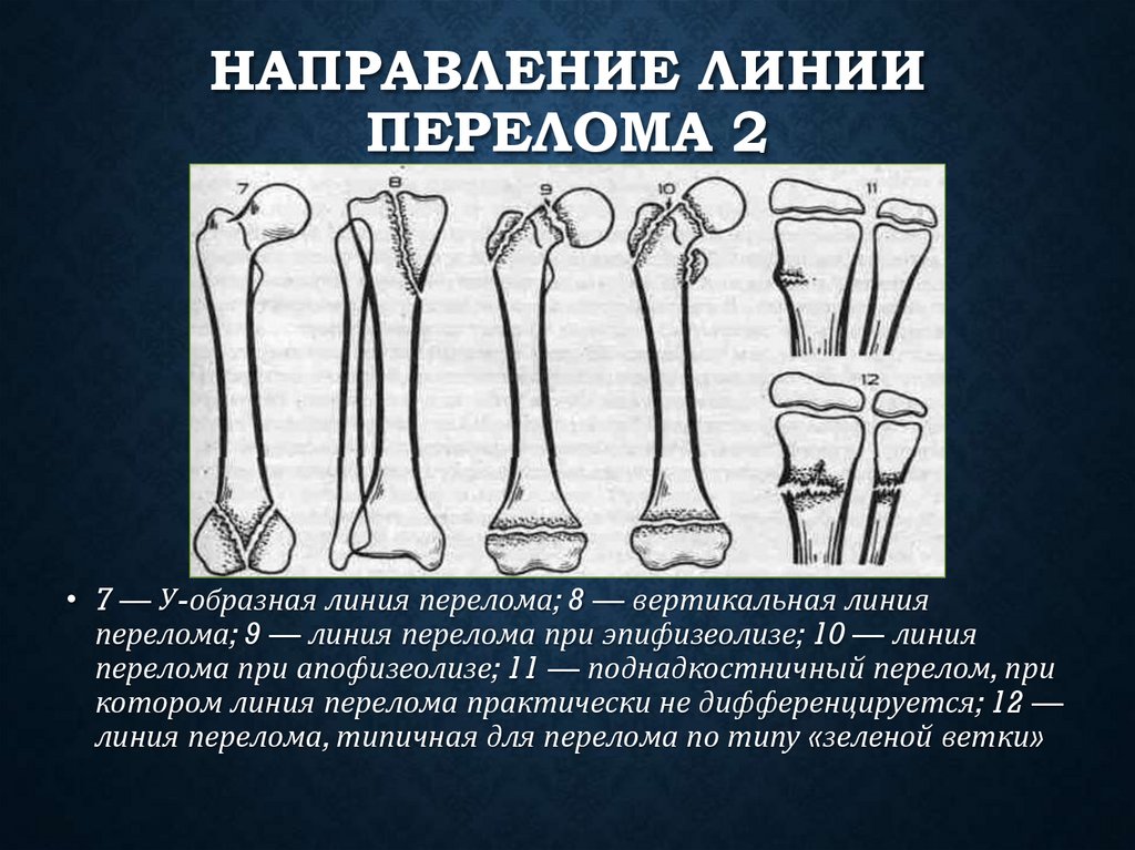 Направление линии перелома 2