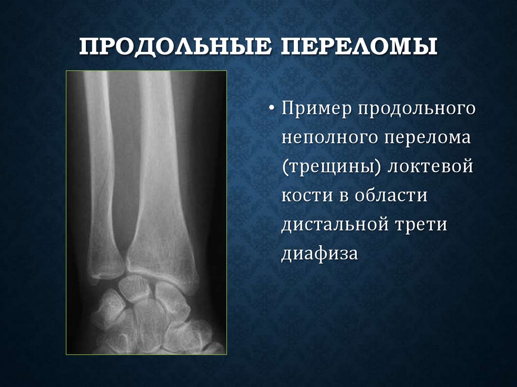 Продольные переломы