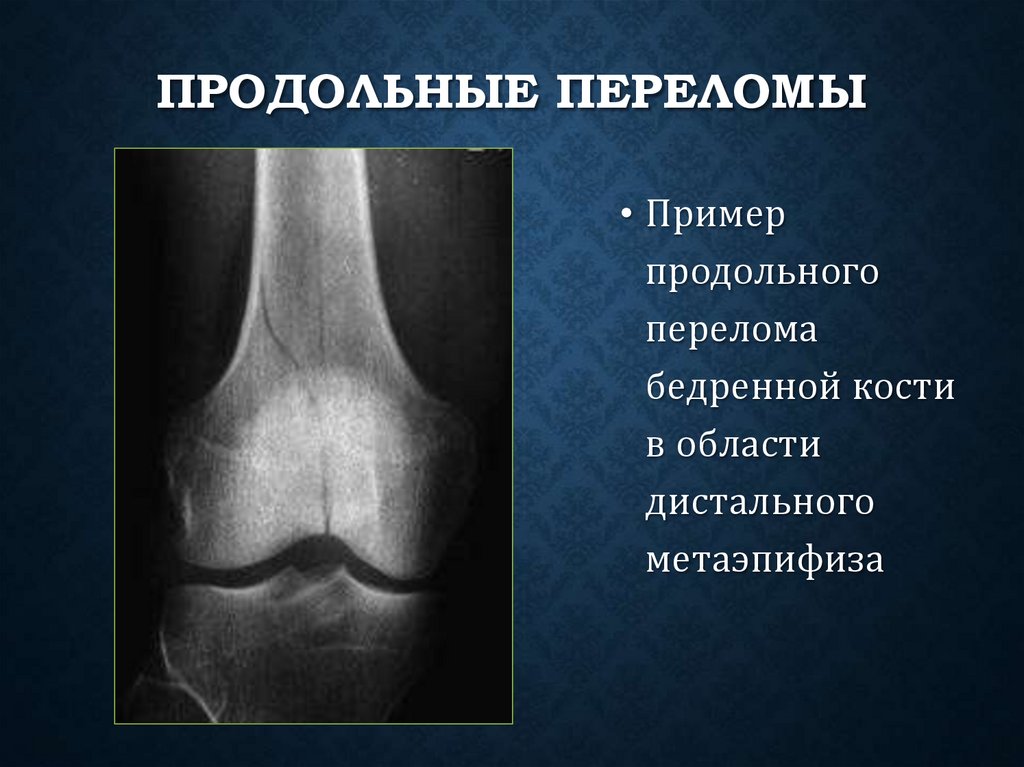 Продольные переломы