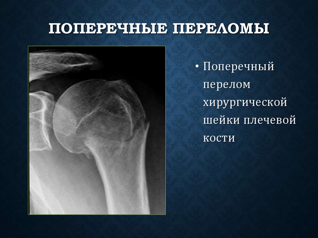 Поперечные переломы