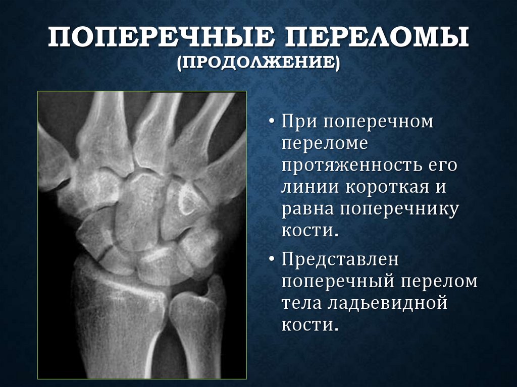 Поперечные переломы (продолжение)