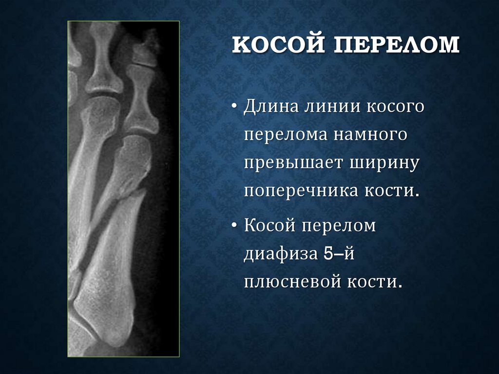 Косой перелом