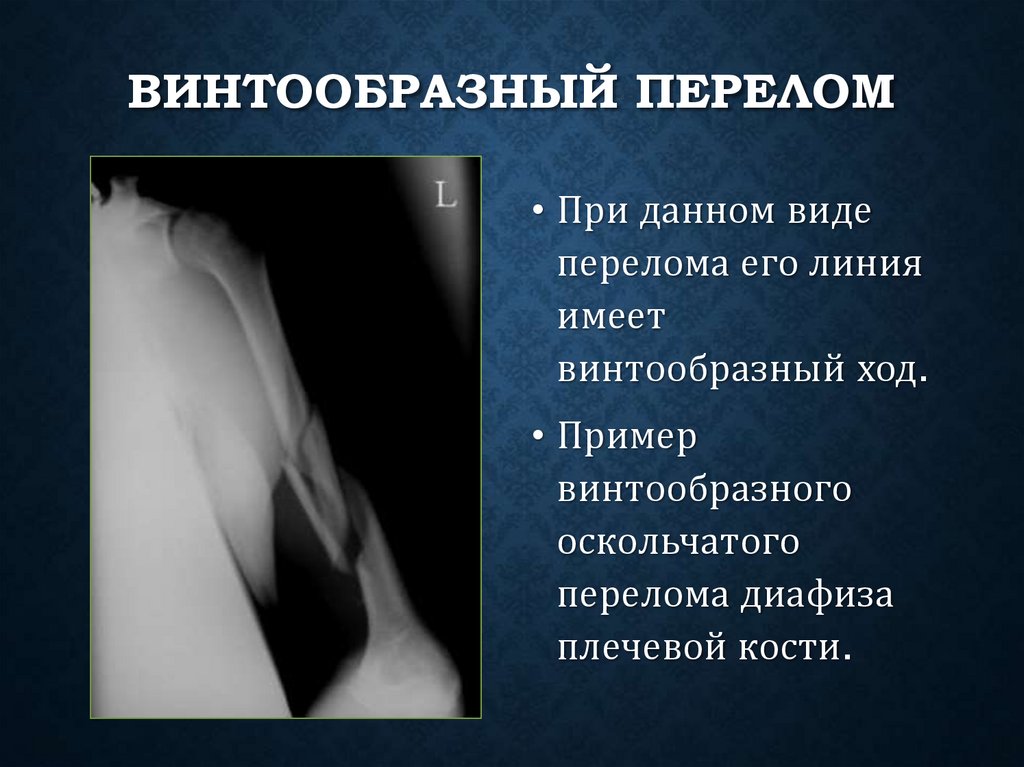 Винтообразный перелом