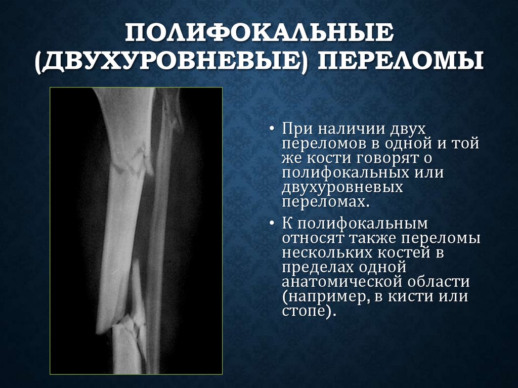 Полифокальные (двухуровневые) переломы
