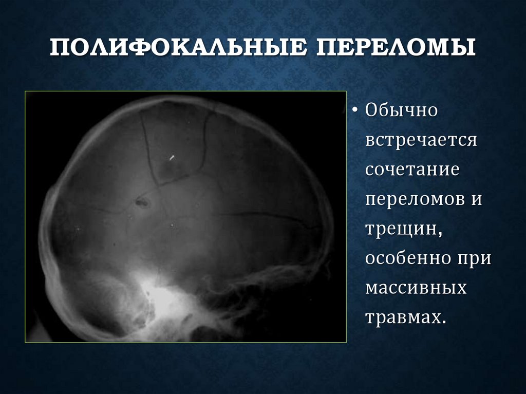 Полифокальные переломы