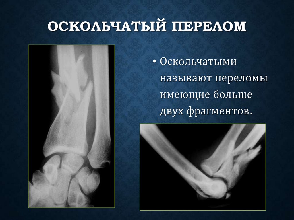 Оскольчатый перелом