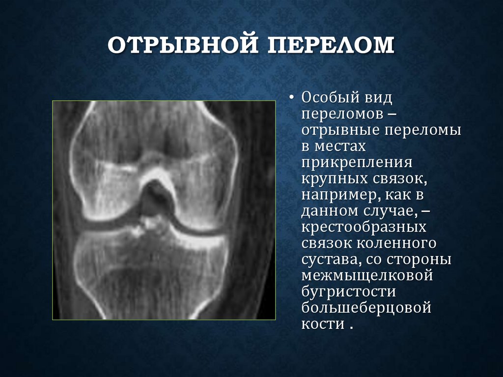 Отрывной перелом