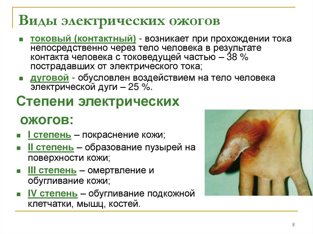 Виды электрических ожогов
